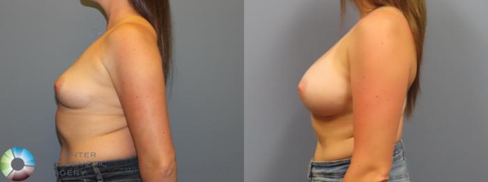 Before & After Breast Augmentation Case 12077 Left Side in Denver and Colorado Springs, CO