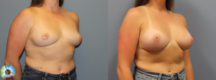 Before & After Breast Augmentation Case 12077 Right Oblique in Denver and Colorado Springs, CO