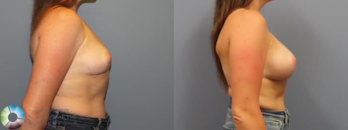 Before & After Breast Augmentation Case 12077 Right Side in Denver and Colorado Springs, CO