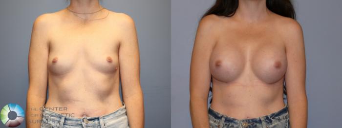 Before & After Breast Augmentation Case 12078 Front in Denver and Colorado Springs, CO