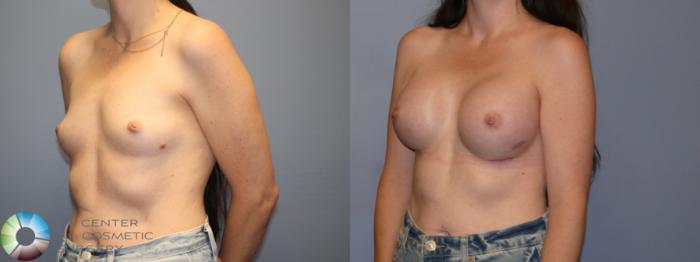 Before & After Breast Augmentation Case 12078 Left Oblique in Denver and Colorado Springs, CO