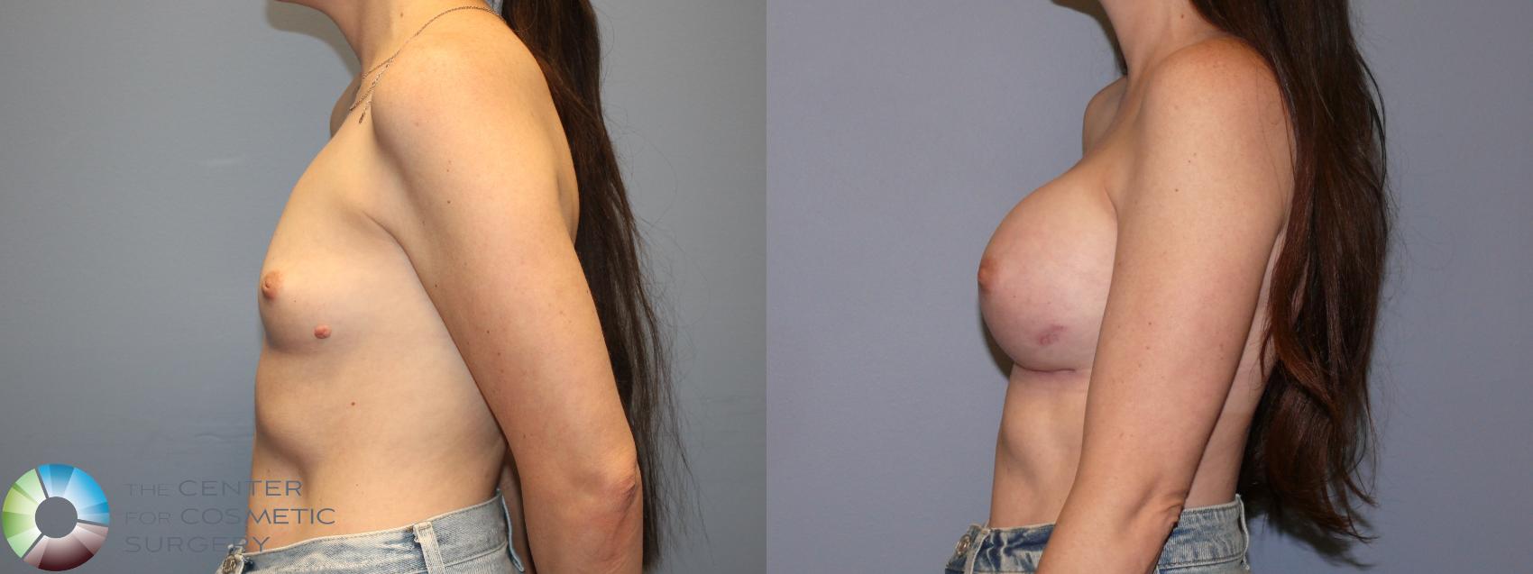 Before & After Breast Augmentation Case 12078 Left Side in Denver and Colorado Springs, CO