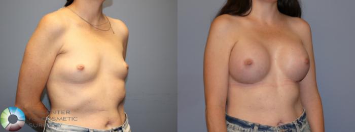 Before & After Breast Augmentation Case 12078 Right Oblique in Denver and Colorado Springs, CO