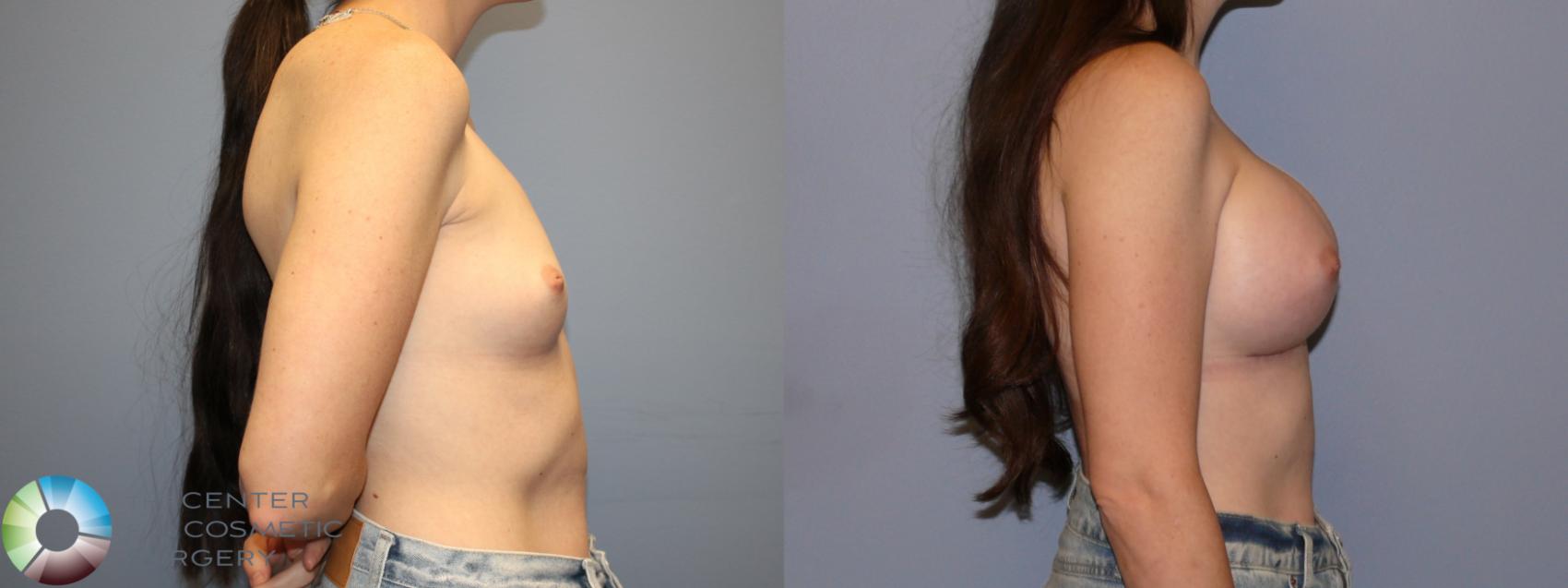 Before & After Breast Augmentation Case 12078 Right Side in Denver and Colorado Springs, CO
