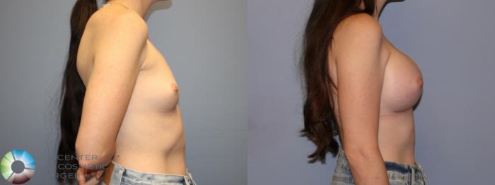 Before & After Breast Augmentation Case 12078 Right Side in Denver and Colorado Springs, CO