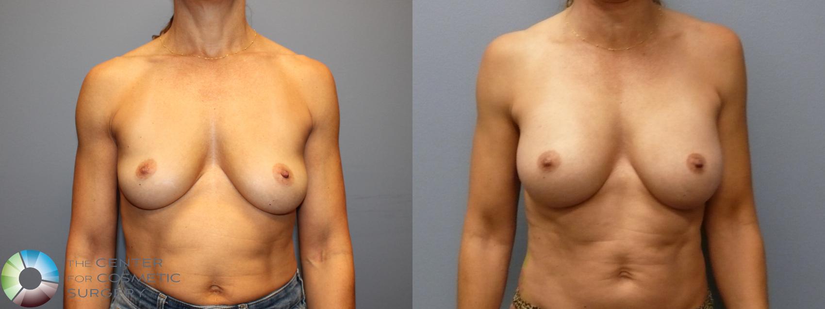 Before & After Breast Augmentation Case 12079 Front in Denver and Colorado Springs, CO