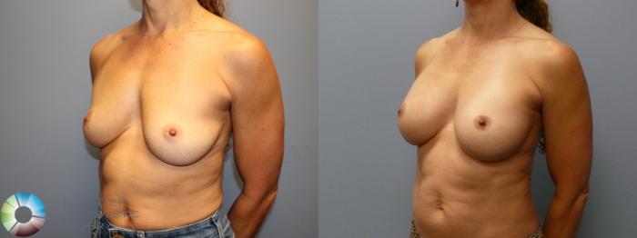 Before & After Breast Augmentation Case 12079 Left Oblique in Denver and Colorado Springs, CO