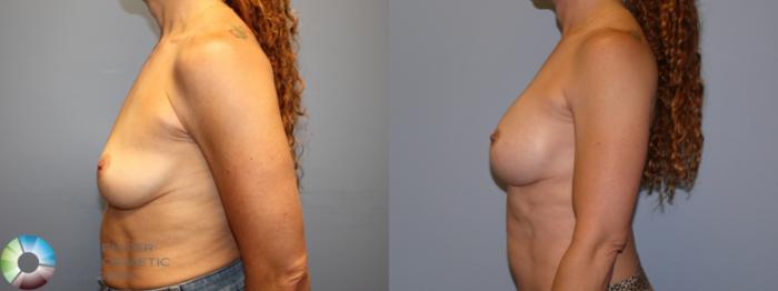 Before & After Breast Augmentation Case 12079 Left Side in Denver and Colorado Springs, CO