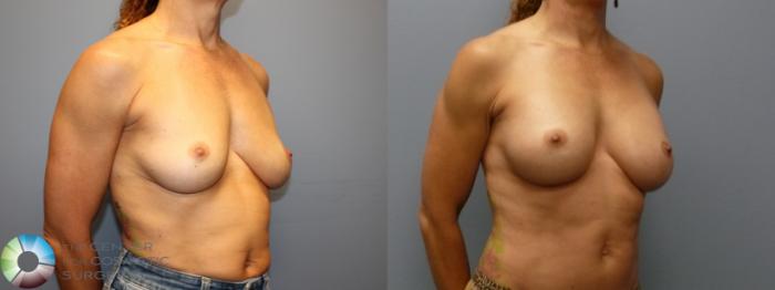 Before & After Breast Augmentation Case 12079 Right Oblique in Denver and Colorado Springs, CO