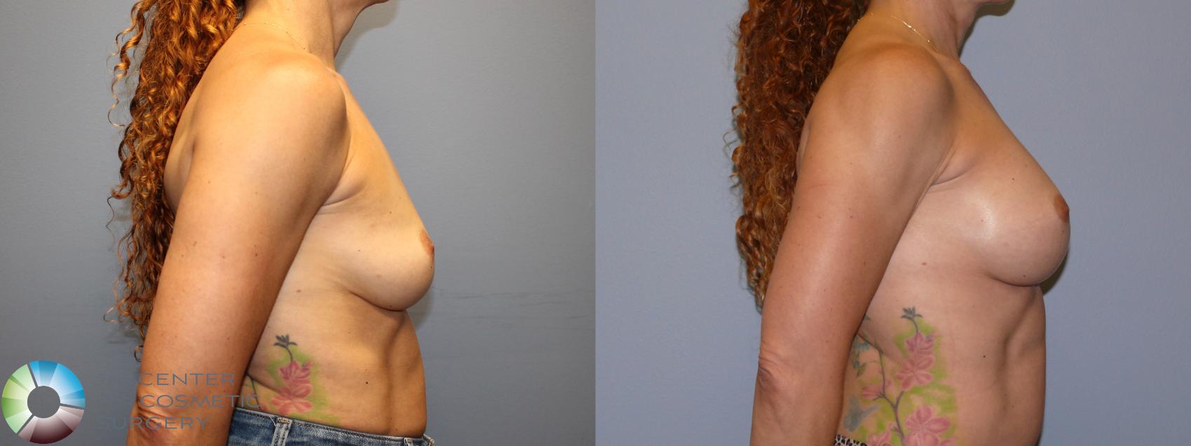 Before & After Breast Augmentation Case 12079 Right Side in Denver and Colorado Springs, CO