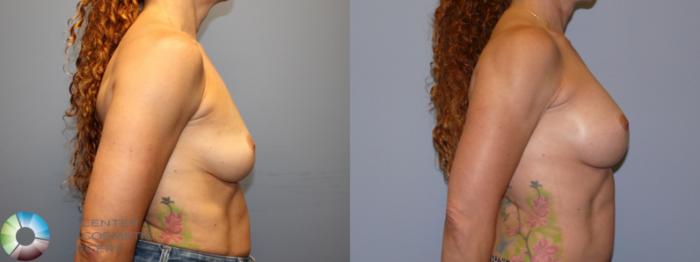 Before & After Breast Augmentation Case 12079 Right Side in Denver and Colorado Springs, CO