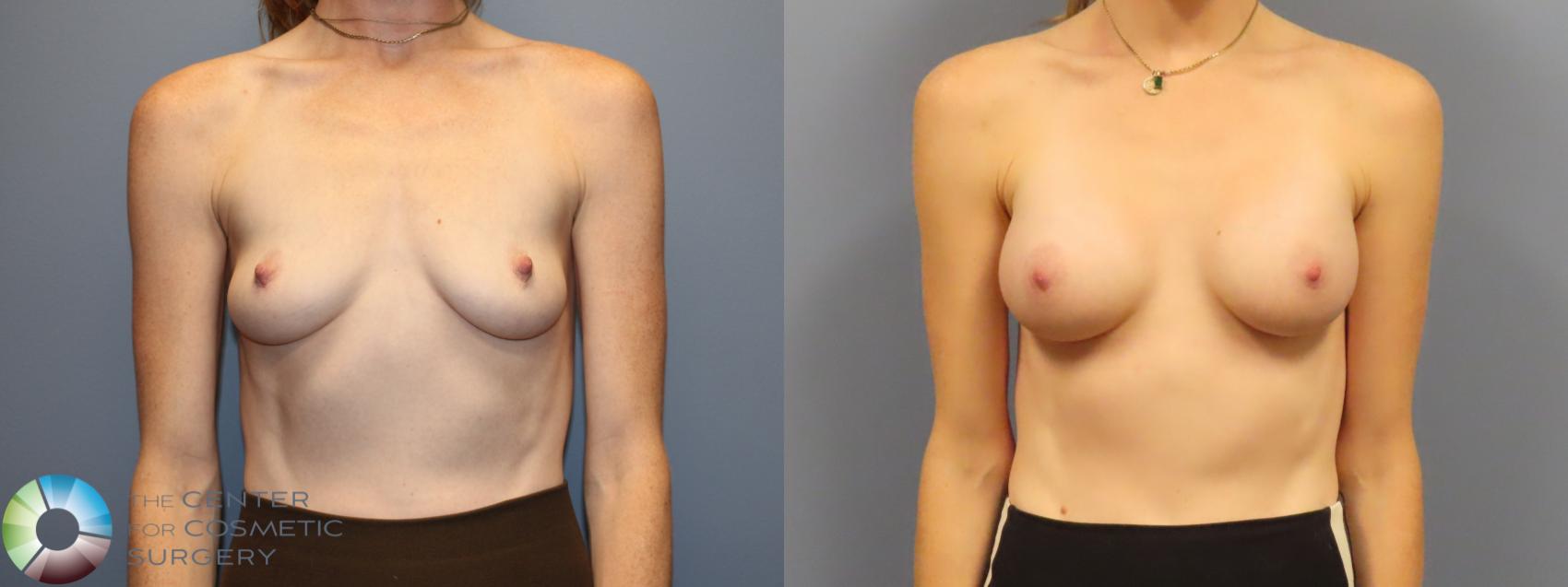 Before & After Breast Augmentation Case 12082 Front in Denver and Colorado Springs, CO