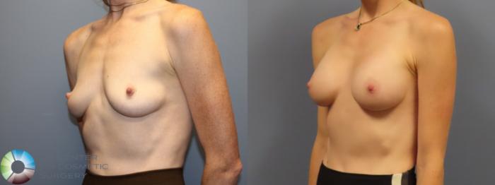 Before & After Breast Augmentation Case 12082 Left Oblique in Denver and Colorado Springs, CO