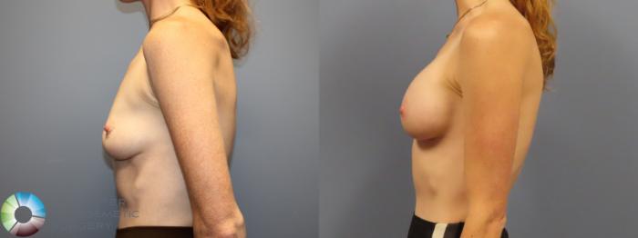 Before & After Breast Augmentation Case 12082 Left Side in Denver and Colorado Springs, CO