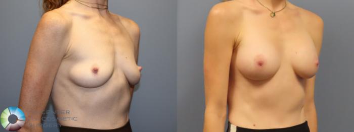 Before & After Breast Augmentation Case 12082 Right Oblique in Denver and Colorado Springs, CO