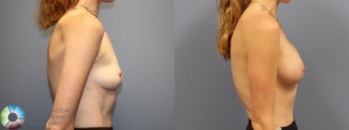 Before & After Breast Augmentation Case 12082 Right Side in Denver and Colorado Springs, CO