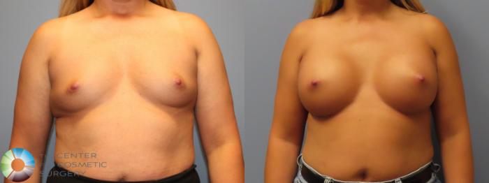 Before & After Breast Augmentation Case 12086 Front in Denver and Colorado Springs, CO