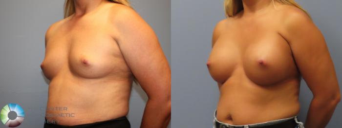 Before & After Breast Augmentation Case 12086 Left Oblique in Denver and Colorado Springs, CO