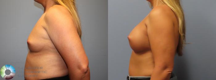 Before & After Breast Augmentation Case 12086 Left Side in Denver and Colorado Springs, CO