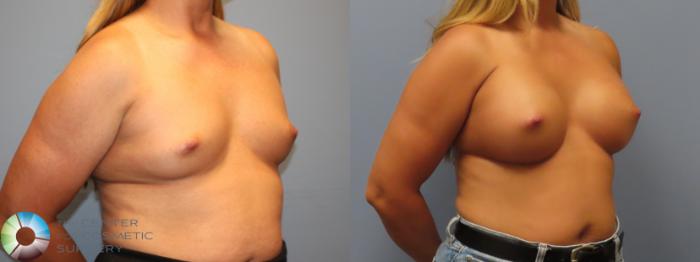 Before & After Breast Augmentation Case 12086 Right Oblique in Denver and Colorado Springs, CO