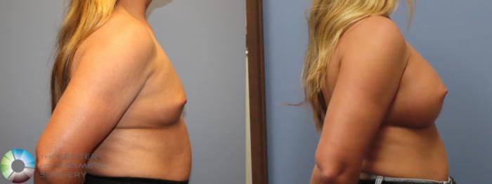 Before & After Breast Augmentation Case 12086 Right Side in Denver and Colorado Springs, CO