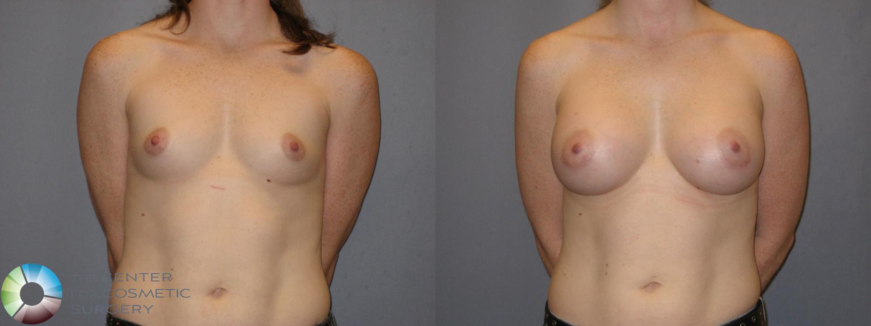 Before & After Breast Augmentation Case 121 View #1 in Denver and Colorado Springs, CO