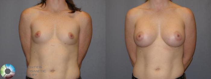 Before & After Breast Augmentation Case 121 View #1 View in Golden, CO