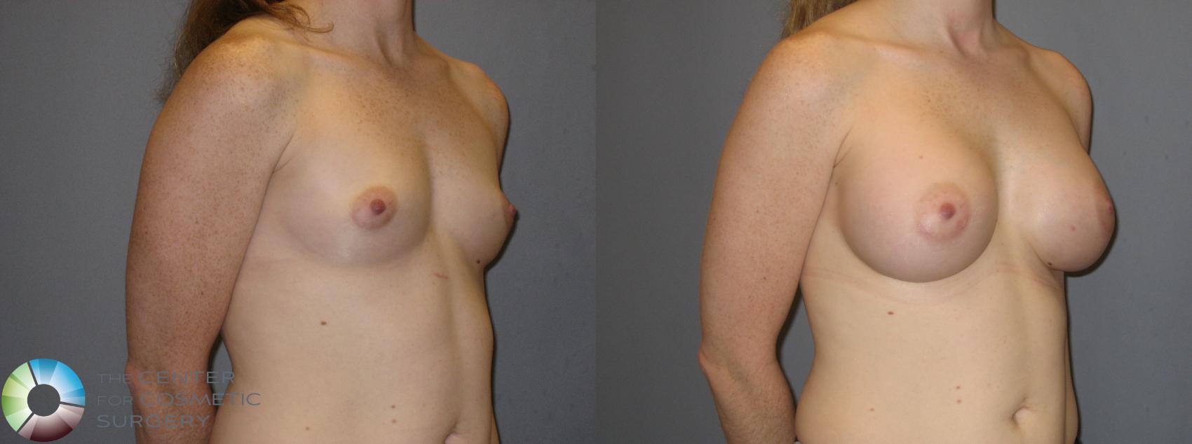 Before & After Breast Augmentation Case 121 View #2 in Denver and Colorado Springs, CO