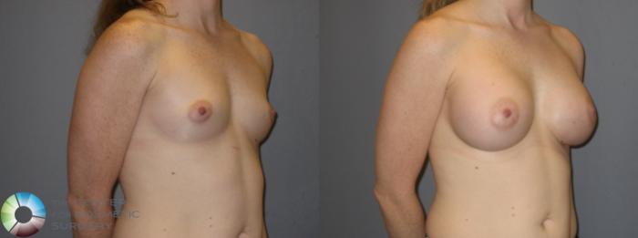 Before & After Breast Augmentation Case 121 View #2 View in Golden, CO