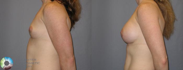 Before & After Breast Augmentation Case 121 View #3 View in Golden, CO