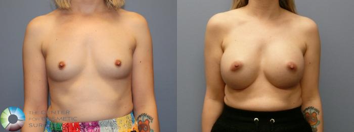 Before & After Breast Augmentation Case 12107 Front in Denver and Colorado Springs, CO