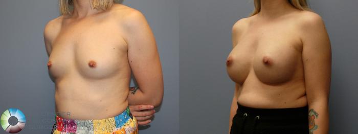 Before & After Breast Augmentation Case 12107 Left Oblique in Denver and Colorado Springs, CO