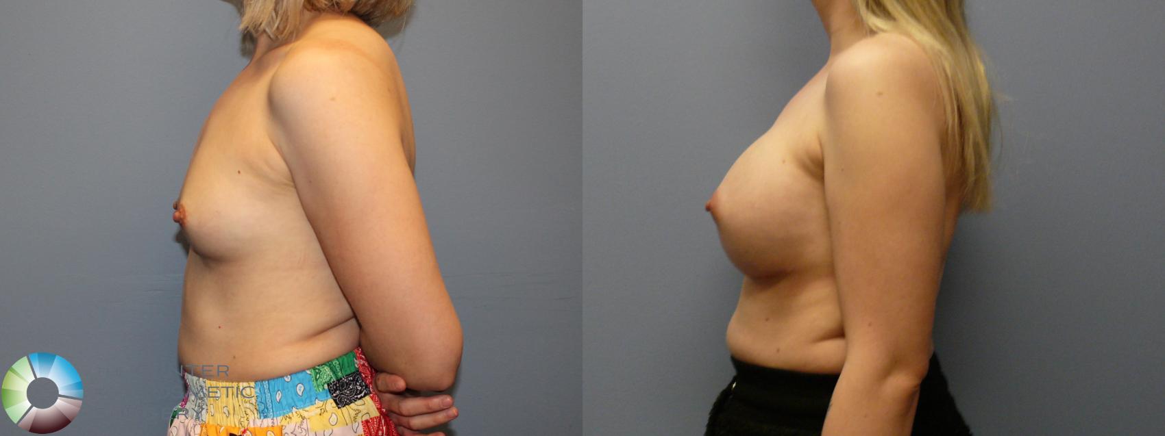 Before & After Breast Augmentation Case 12107 Left Side in Denver and Colorado Springs, CO