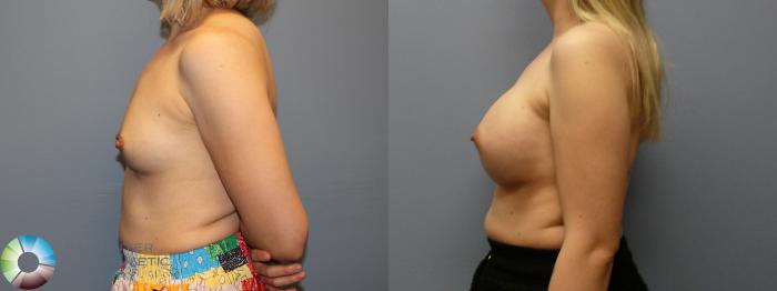 Before & After Breast Augmentation Case 12107 Left Side in Denver and Colorado Springs, CO