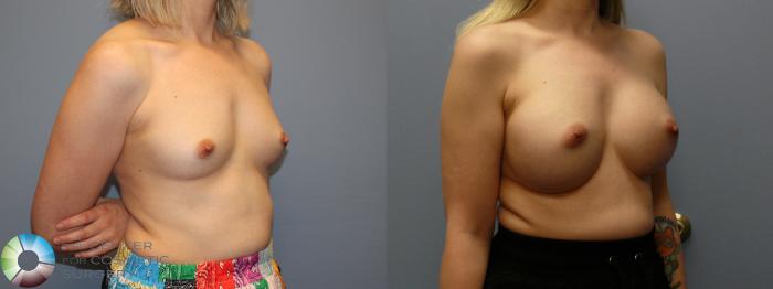 Before & After Breast Augmentation Case 12107 Right Oblique in Denver and Colorado Springs, CO