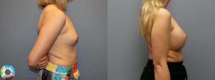 Before & After Breast Augmentation Case 12107 Right Side in Denver and Colorado Springs, CO