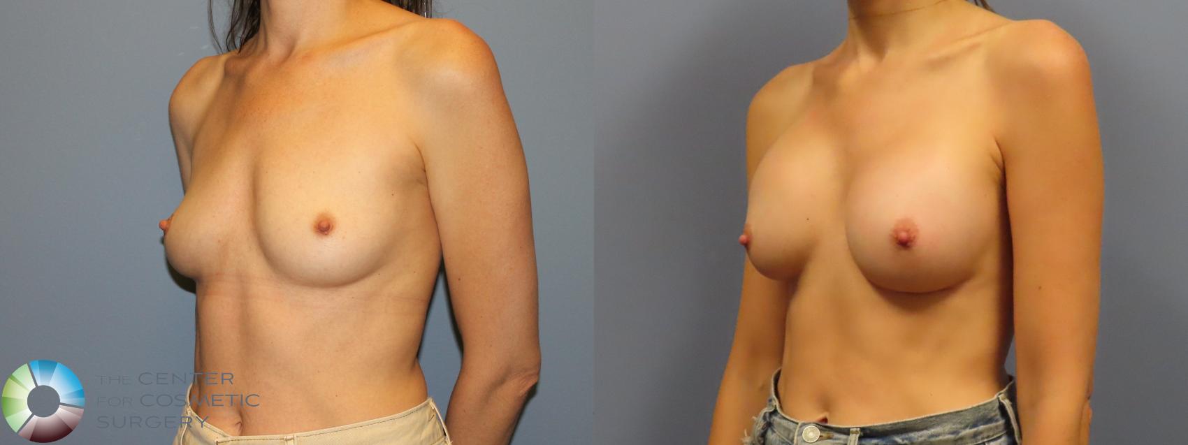 Before & After Breast Augmentation Case 12114 Left Oblique in Denver and Colorado Springs, CO