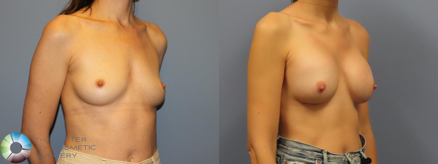 Before & After Breast Augmentation Case 12114 Right Oblique in Denver and Colorado Springs, CO