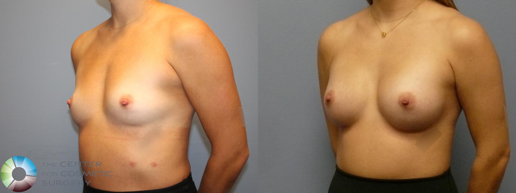 Before & After Breast Augmentation Case 12122 Left Oblique in Denver and Colorado Springs, CO
