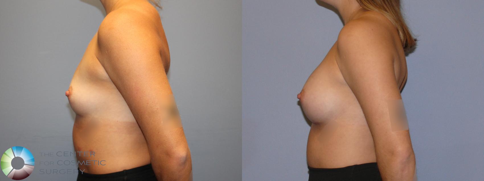 Before & After Breast Augmentation Case 12122 Left Side in Denver and Colorado Springs, CO
