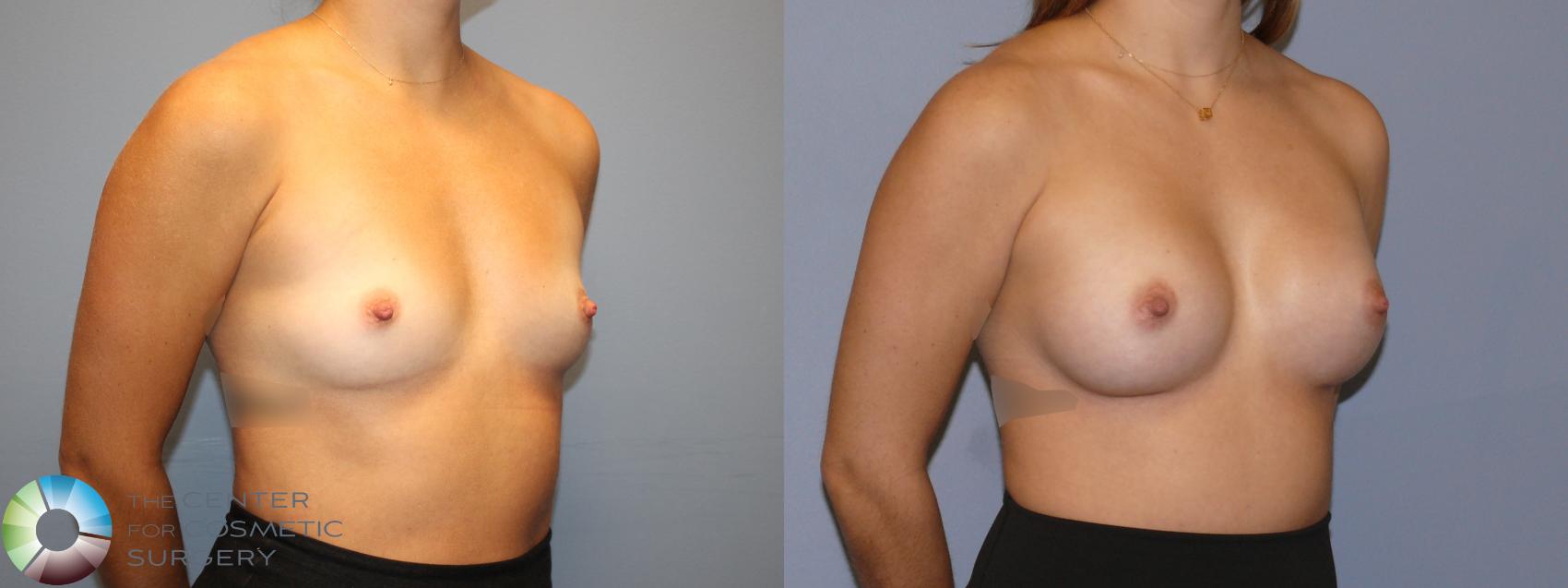 Before & After Breast Augmentation Case 12122 Right Oblique in Denver and Colorado Springs, CO
