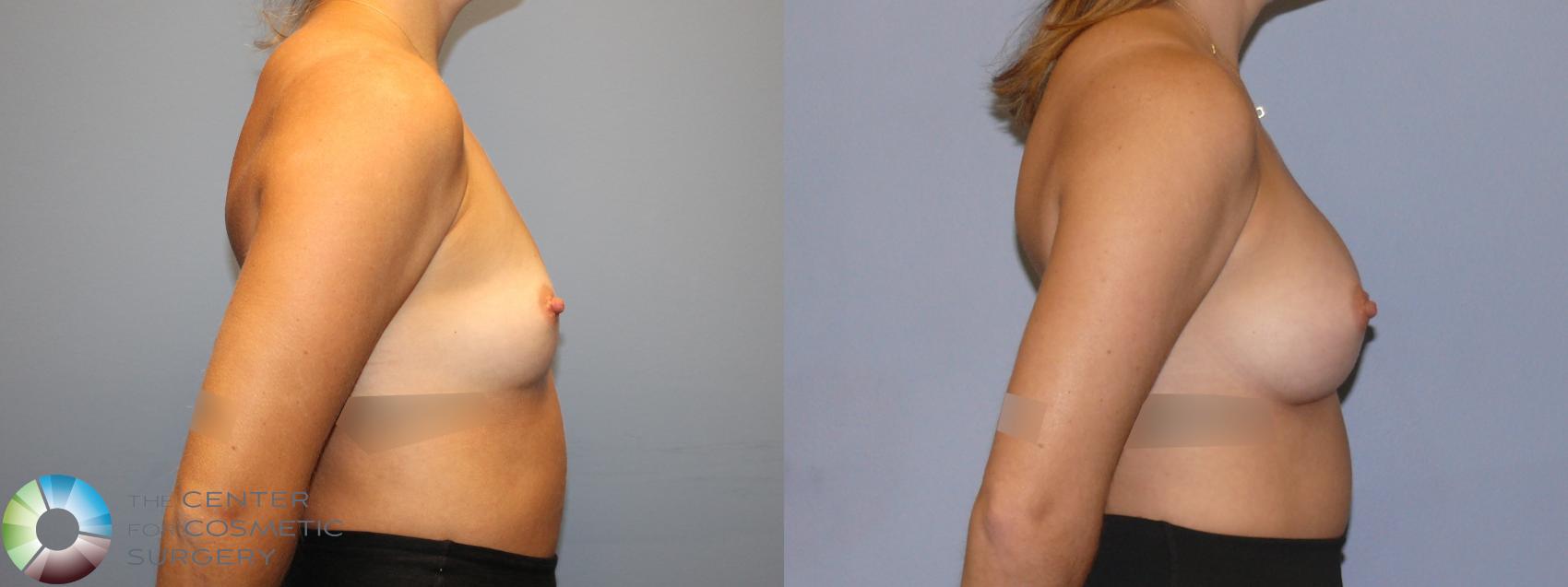 Before & After Breast Augmentation Case 12122 Right Side in Denver and Colorado Springs, CO