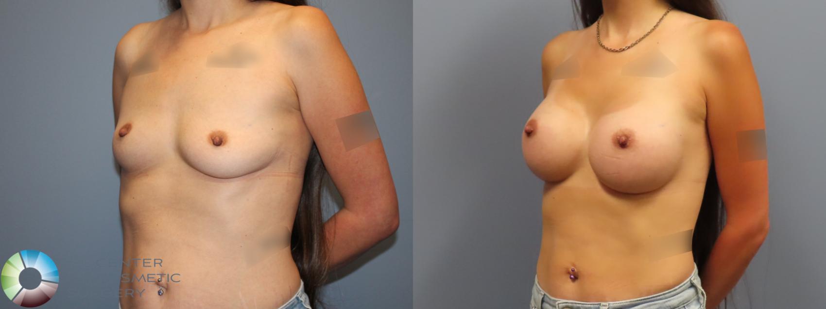 Before & After Breast Augmentation Case 12123 Left Oblique in Denver and Colorado Springs, CO