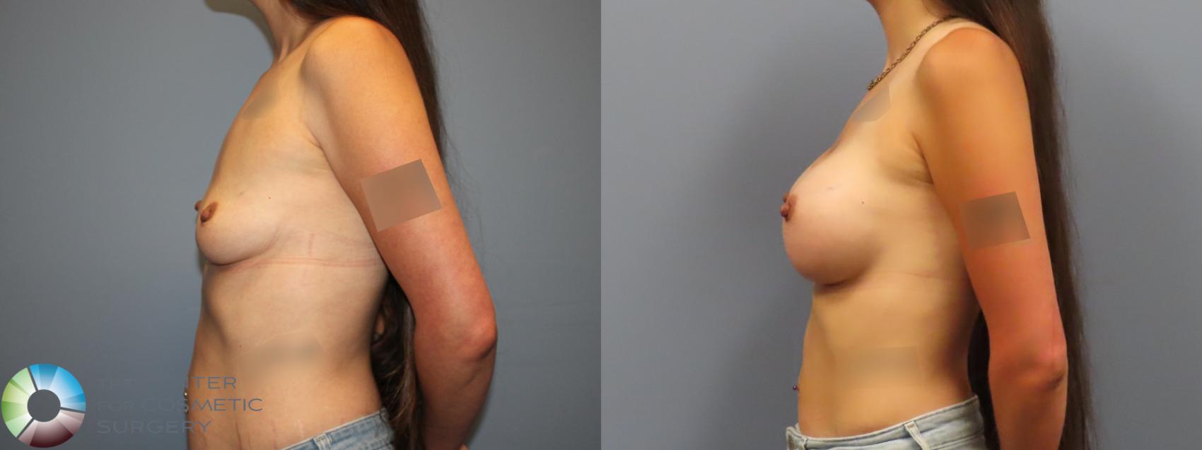 Before & After Breast Augmentation Case 12123 Left Side in Denver and Colorado Springs, CO
