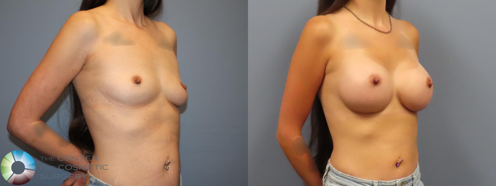 Before & After Breast Augmentation Case 12123 Right Oblique in Denver and Colorado Springs, CO