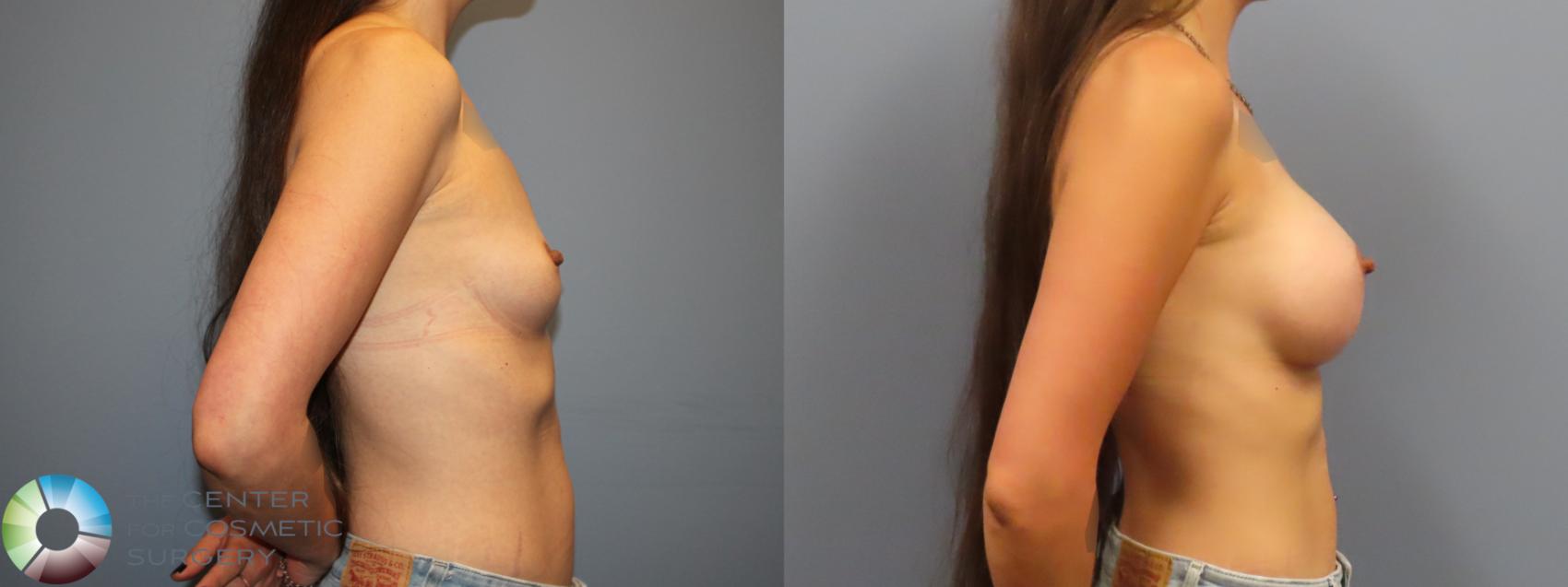 Before & After Breast Augmentation Case 12123 Right Side in Denver and Colorado Springs, CO