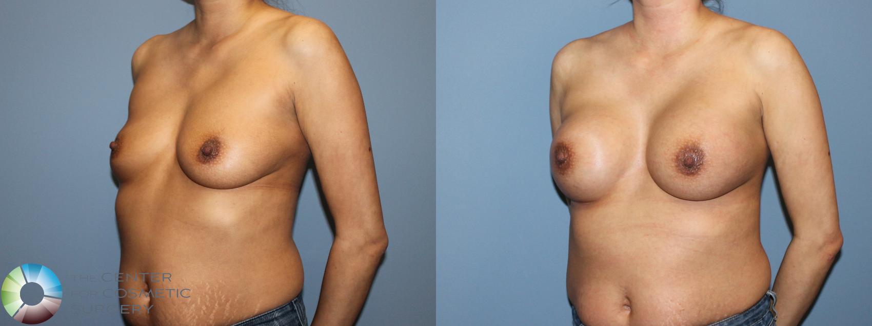 Before & After Breast Augmentation Case 12124 Left Oblique in Denver and Colorado Springs, CO