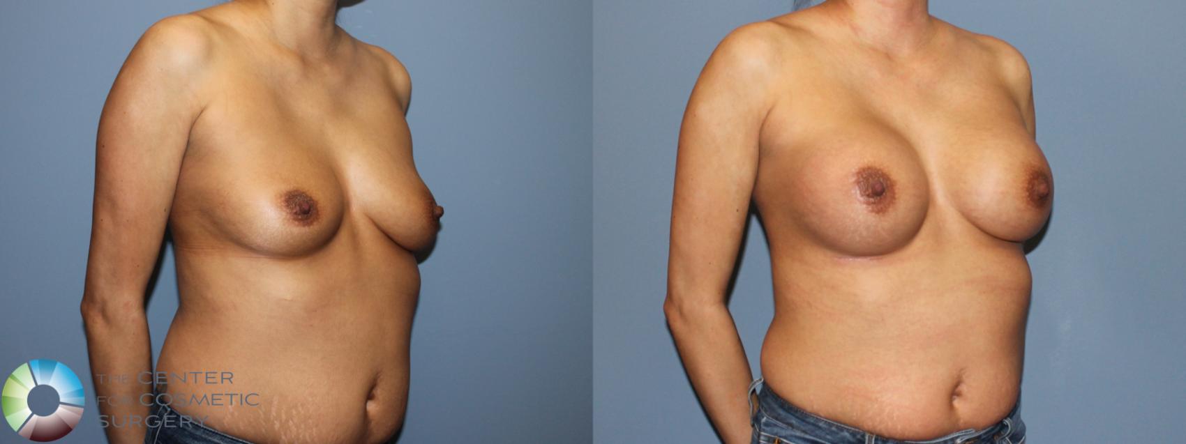 Before & After Breast Augmentation Case 12124 Right Oblique in Denver and Colorado Springs, CO