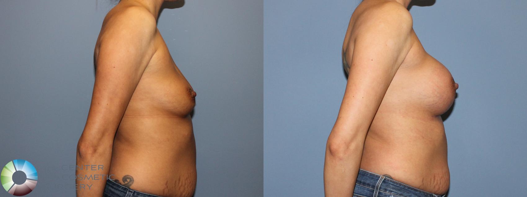 Before & After Breast Augmentation Case 12124 Right Side in Denver and Colorado Springs, CO
