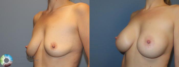 Best Denver Breast Augmentation/Motiva Implants